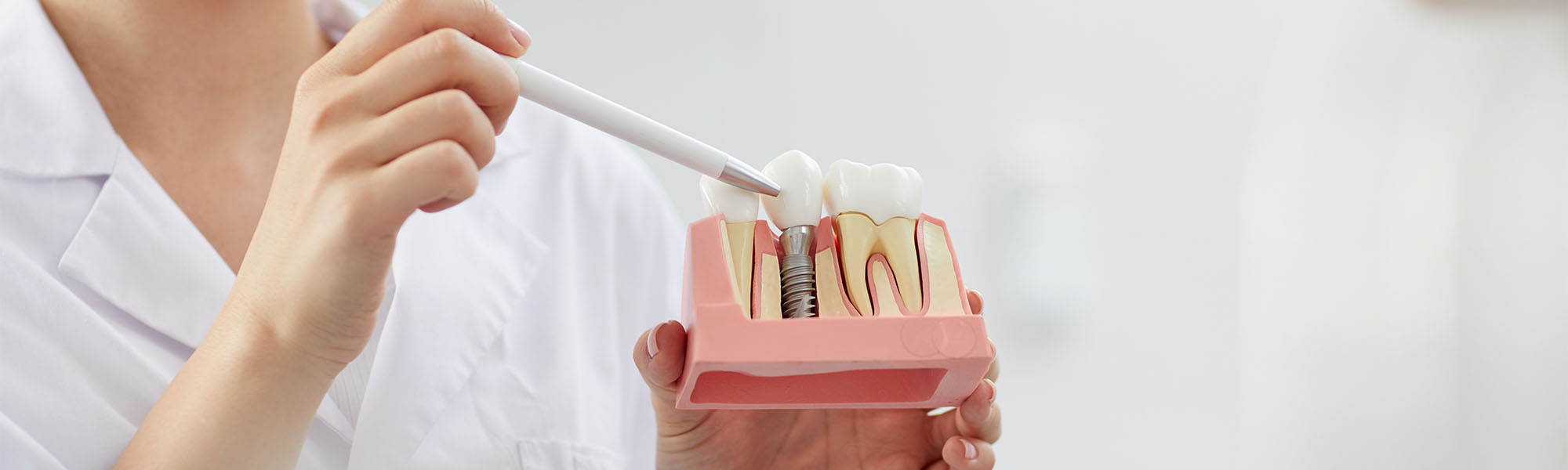 Single Tooth Implants Whittier CA