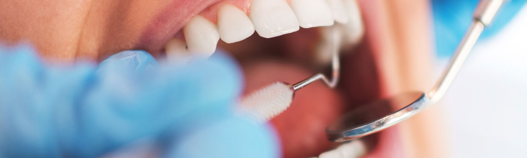 Tooth Extraction Whittier CA