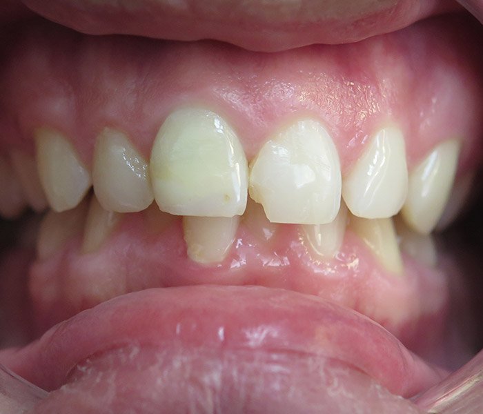 Before composite tooth-colored fillings, case 1 at Dentists of Whittier in Whittier, CA