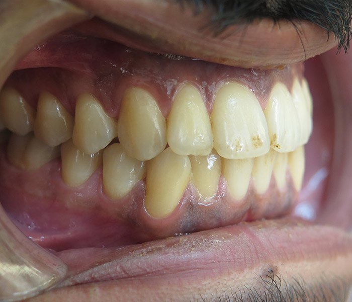 Before stain removal and teeth cleaning, case 3 at Dentists of Whittier in Whittier, CA