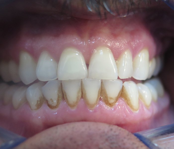 Before dental cleaning treatment, case 4 at Dentists of Whittier in Whittier, CA