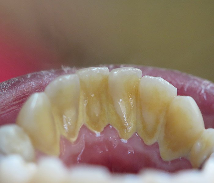 Before dental cleaning and polishing, case 2 at Dentists of Whittier in Whittier, CA