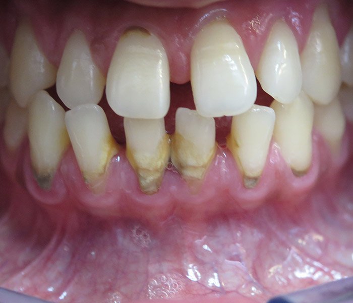 Before professional teeth cleaning, case 1 at Dentists of Whittier in Whittier, CA