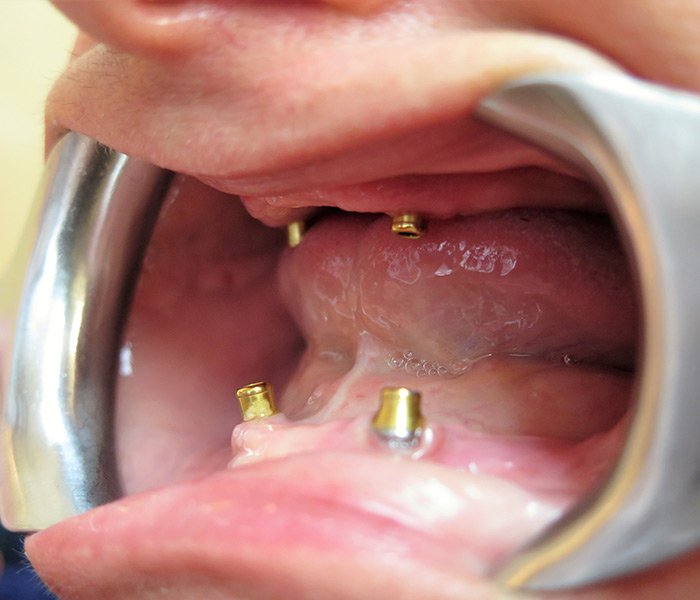 Before All-on-4 dental implants, case 3 at Dentists of Whittier in Whittier, CA