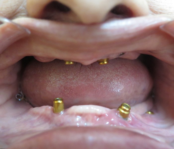 Before All-on-4 dental implants, case 4 at Dentists of Whittier in Whittier, CA