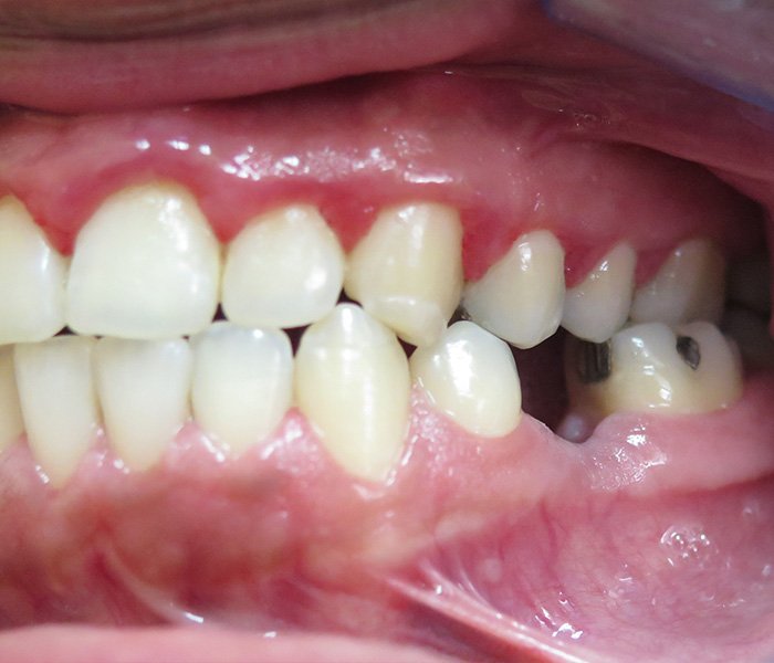 Before dental implant restoration, case 2 at Dentists of Whittier in Whittier, CA