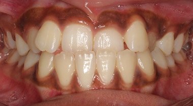 Before orthodontic treatment to straighten teeth, case 1 at Dentists of Whittier in Whittier, CA