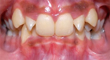 Before orthodontic braces treatment, case 2 at Dentists of Whittier in Whittier, CA