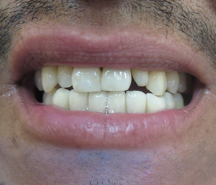 Before veneers smile makeover, case 2 at Dentists of Whittier in Whittier, CA