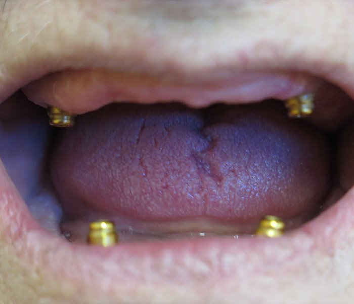 Before All-on-4 dental implants, case 1 at Dentists of Whittier in Whittier, CA