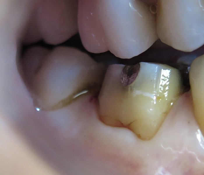 Before dental crown treatment, case 1 at Dentists of Whittier in Whittier, CA