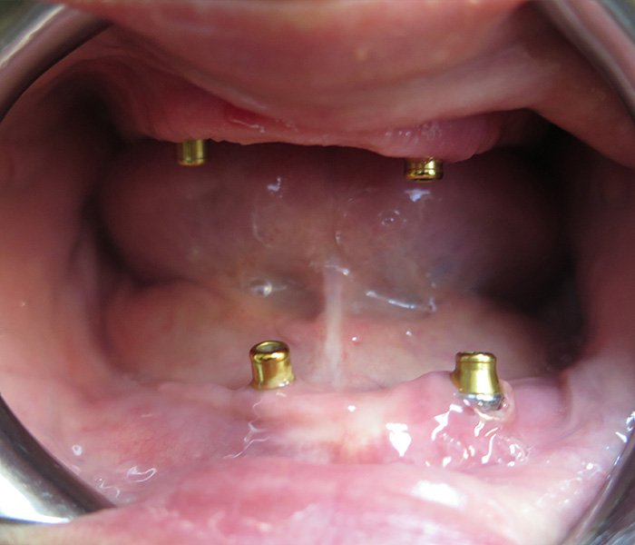 Before All-on-4 dental implants, case 2 at Dentists of Whittier in Whittier, CA