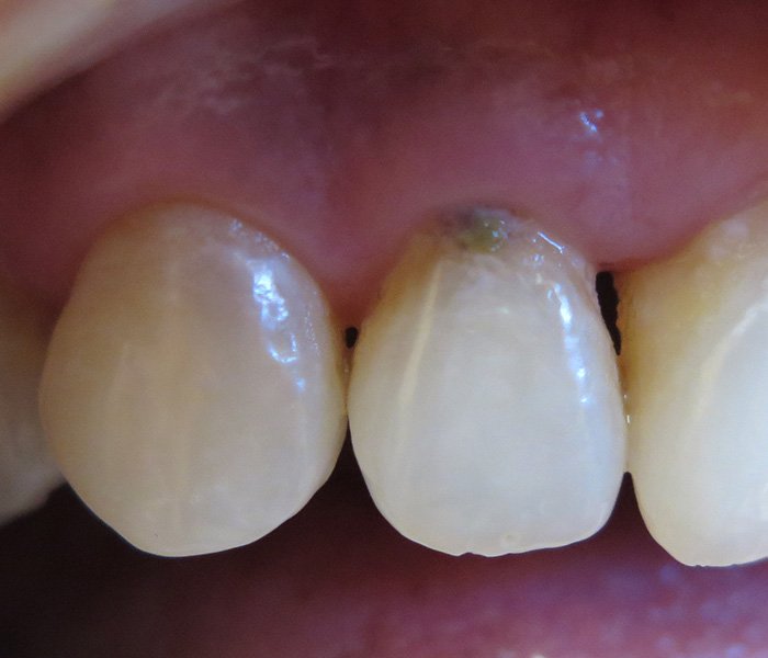Before composite dental fillings, case 2 at Dentists of Whittier in Whittier, CA