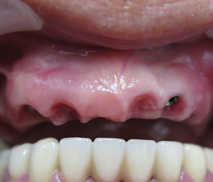 Before dental implant smile makeover, case 3 at Dentists of Whittier in Whittier, CA