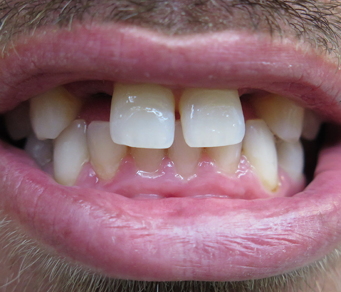 Before dental implant restoration, case 4 at Dentists of Whittier in Whittier, CA