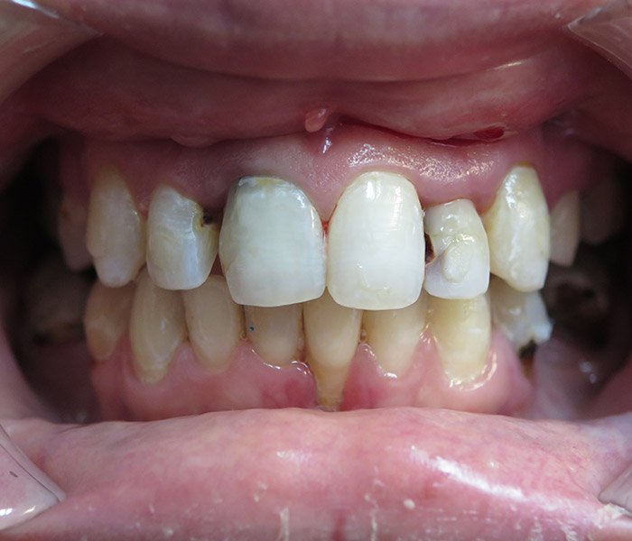 Before single or multiple dental implants, case 1 at Dentists of Whittier in Whittier, CA