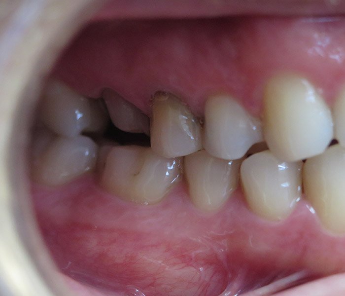 Before dental crown treatment, case 2 at Dentists of Whittier in Whittier, CA