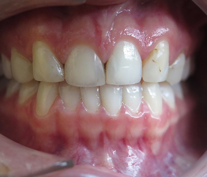 Before porcelain veneers cosmetic treatment, case 1 at Dentists of Whittier in Whittier, CA