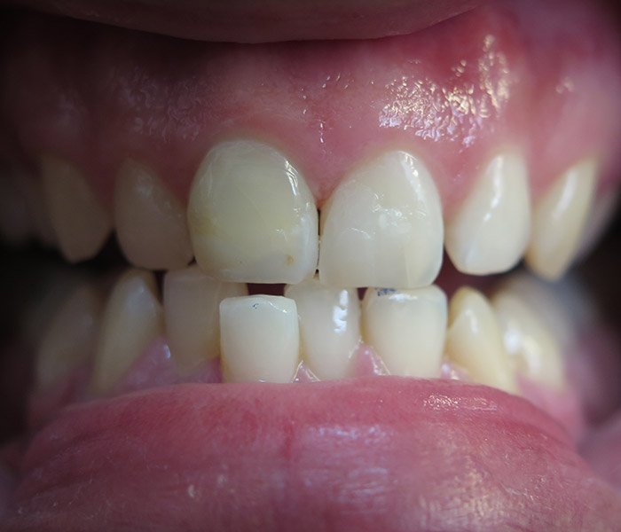 After composite tooth-colored fillings, case 1 at Dentists of Whittier in Whittier, CA