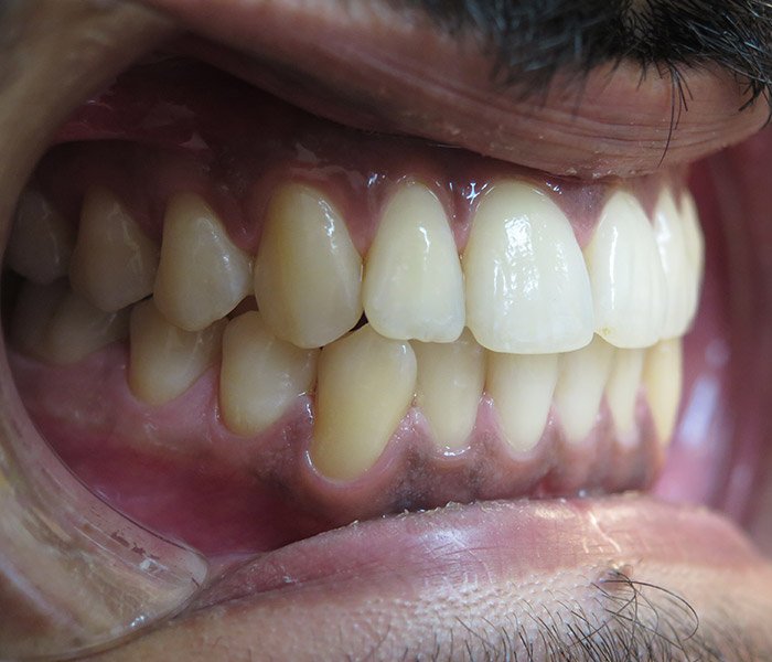 After stain removal and teeth cleaning, case 3 at Dentists of Whittier in Whittier, CA