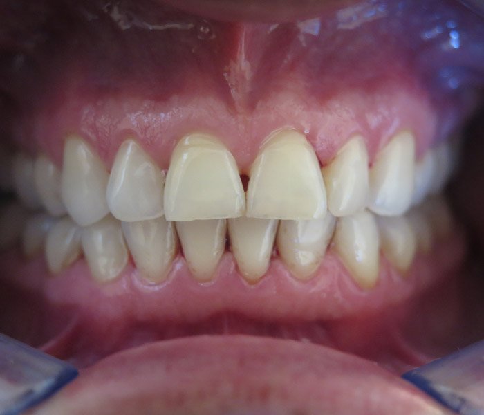 After dental cleaning treatment, case 4 at Dentists of Whittier in Whittier, CA