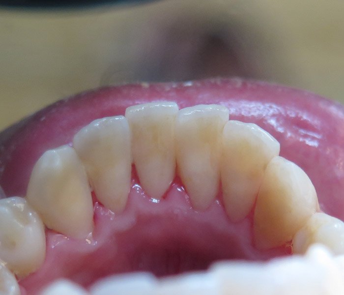 After dental cleaning and polishing, case 2 at Dentists of Whittier in Whittier, CA