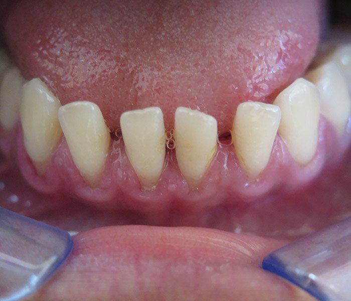 After professional teeth cleaning, case 1 at Dentists of Whittier in Whittier, CA