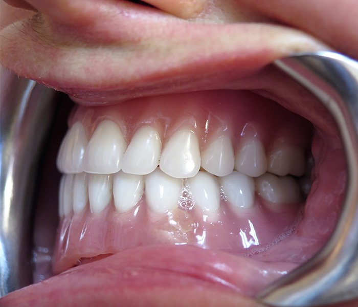 After All-on-4 dental implants, case 3 at Dentists of Whittier in Whittier, CA