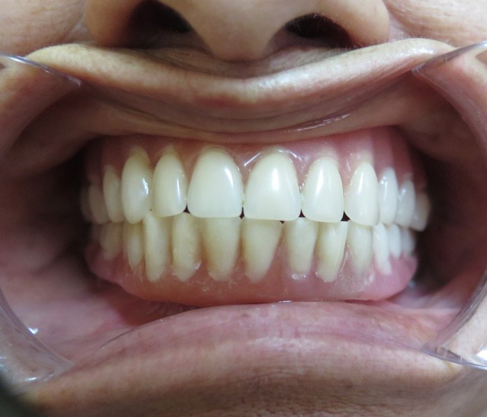 After All-on-4 dental implants, case 4 at Dentists of Whittier in Whittier, CA