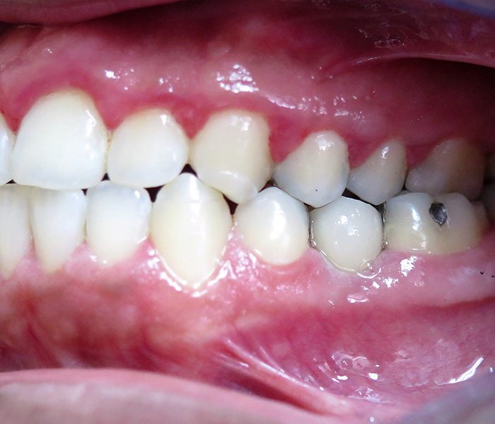 After dental implant restoration, case 2 at Dentists of Whittier in Whittier, CA