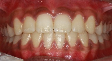 After orthodontic treatment to straighten teeth, case 1 at Dentists of Whittier in Whittier, CA