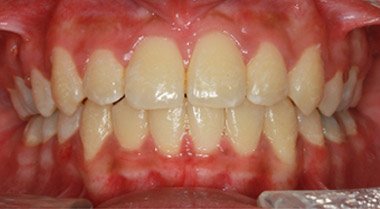 After orthodontic braces treatment, case 2 at Dentists of Whittier in Whittier, CA