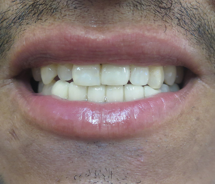 After veneers smile makeover, case 2 at Dentists of Whittier in Whittier, CA