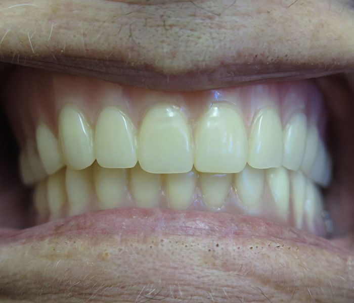 After All-on-4 dental implants, case 1 at Dentists of Whittier in Whittier, CA
