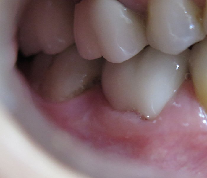 After dental crown treatment, case 1 at Dentists of Whittier in Whittier, CA