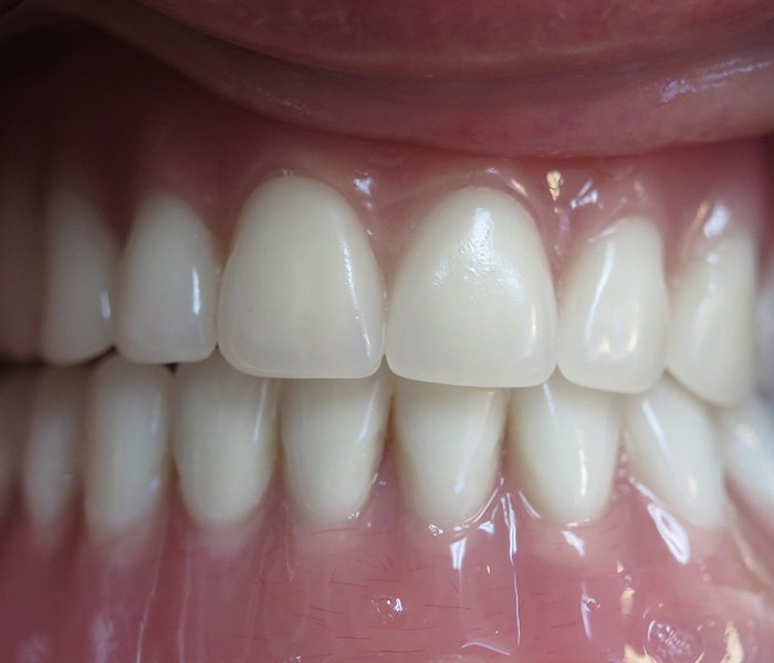 After All-on-4 dental implants, case 2 at Dentists of Whittier in Whittier, CA