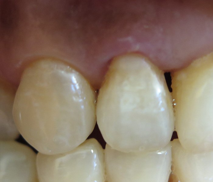 After composite dental fillings, case 2 at Dentists of Whittier in Whittier, CA