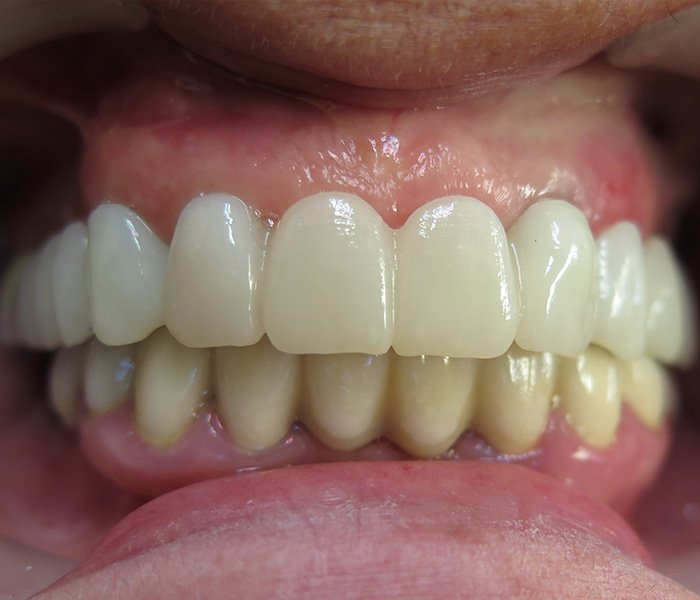 After dental implant smile makeover, case 3 at Dentists of Whittier in Whittier, CA