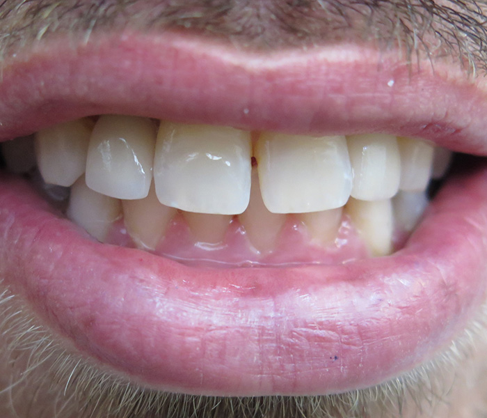 After dental implant restoration, case 4 at Dentists of Whittier in Whittier, CA