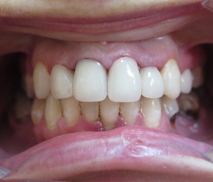 After single or multiple dental implants, case 1 at Dentists of Whittier in Whittier, CA