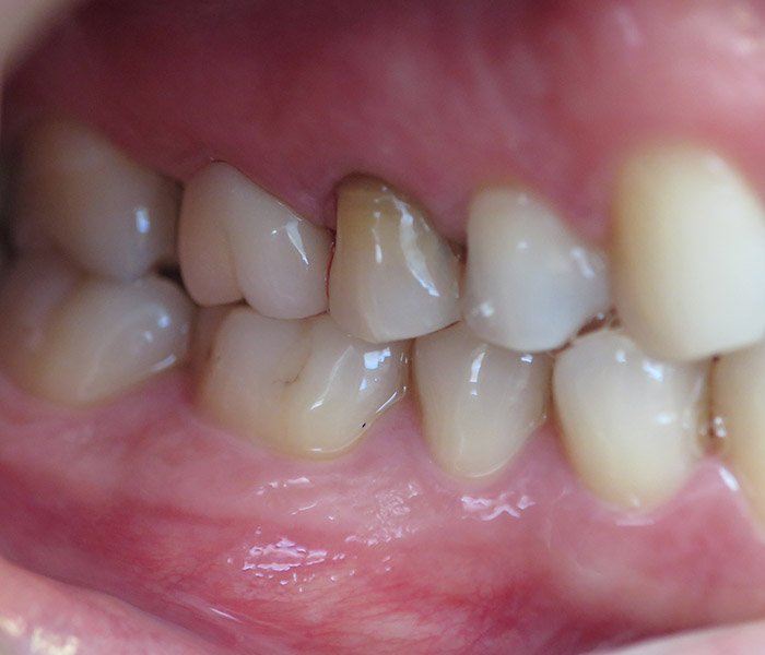 After dental crown treatment, case 2 at Dentists of Whittier in Whittier, CA