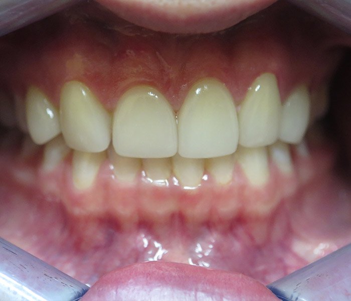 After porcelain veneers cosmetic treatment, case 1 at Dentists of Whittier in Whittier, CA