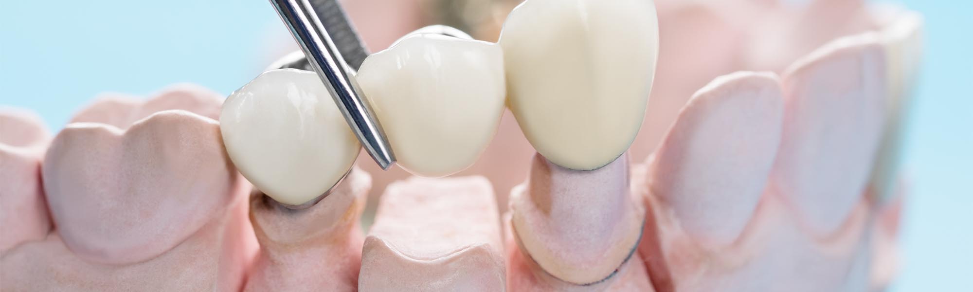 Traditonal Dental Bridge Whittier CA