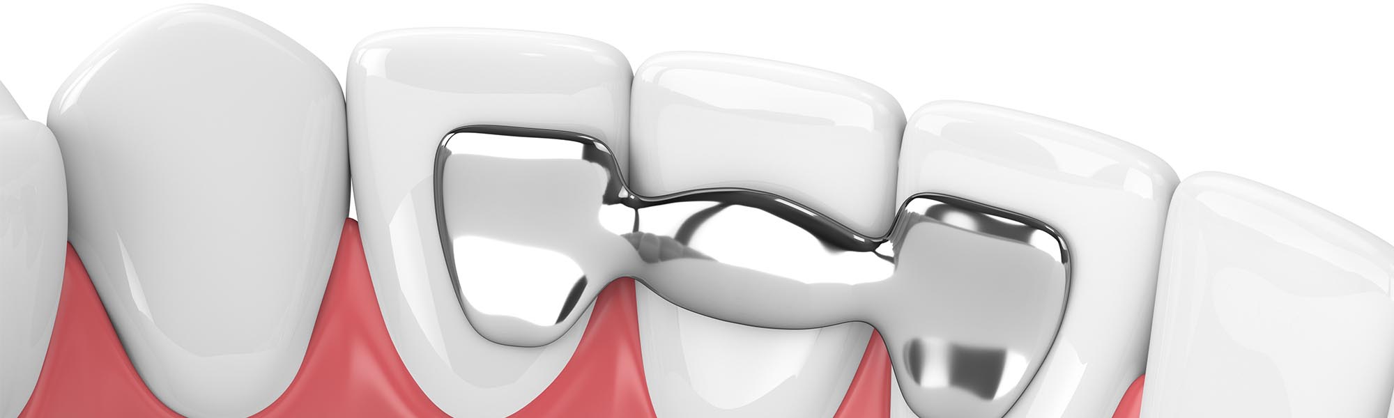 Type of Dental Bridges Whittier CA