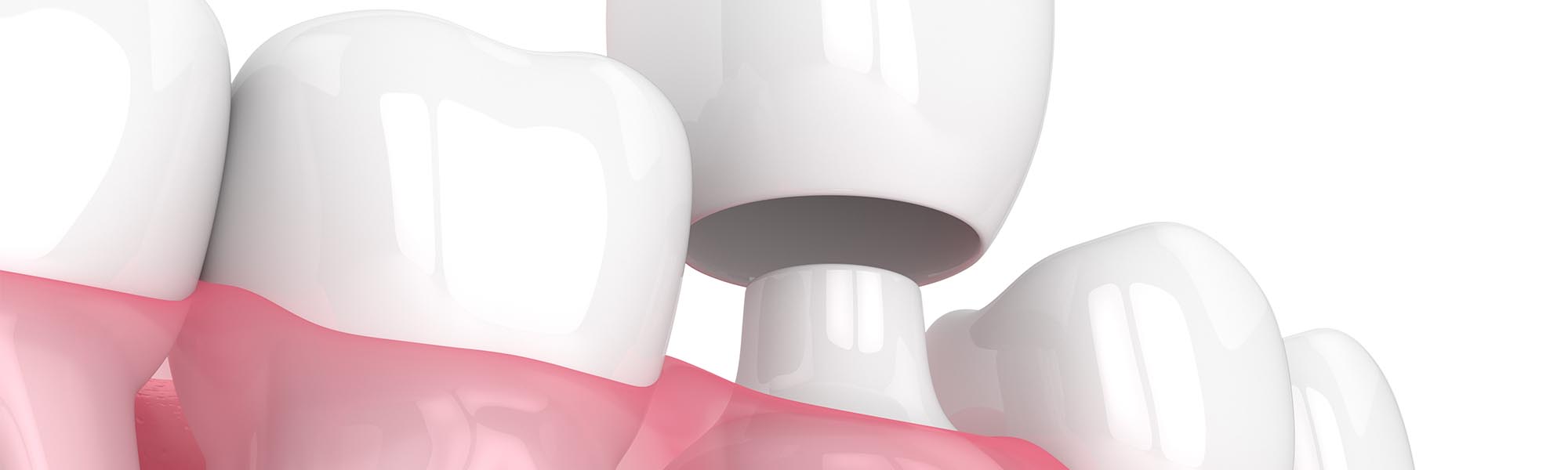 Dental Crowns Material Whittier CA