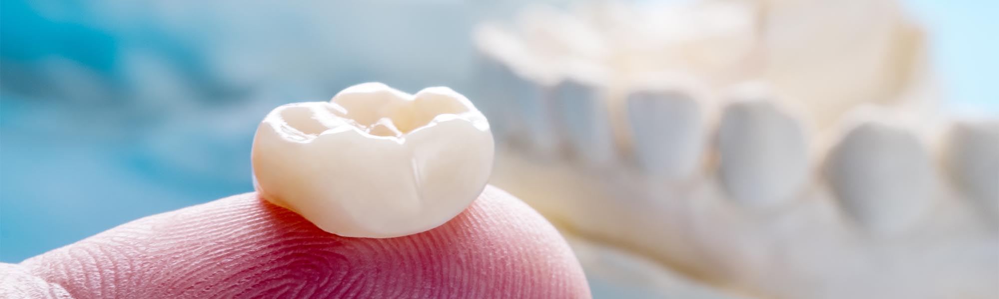 Porcelain Crowns Dentist Whittier CA