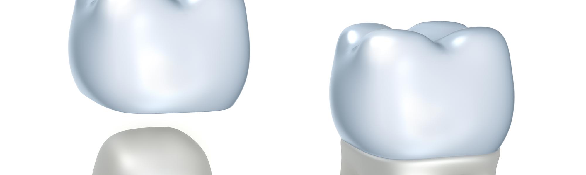Porcelain Crowns Whittier CA
