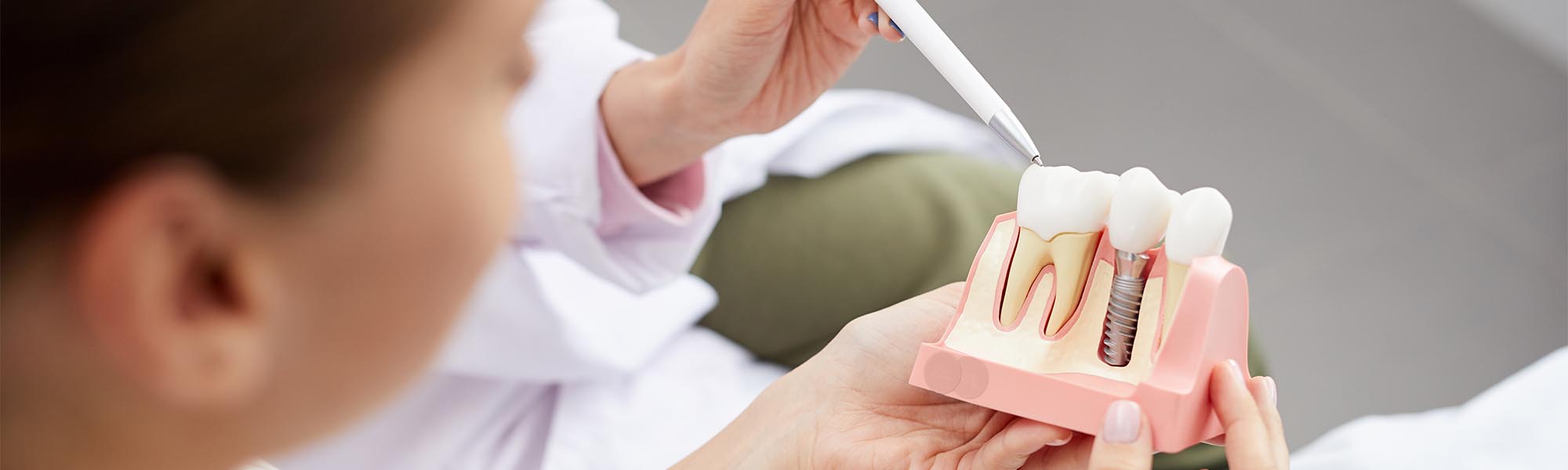 Dental Implants in Whittier CA
