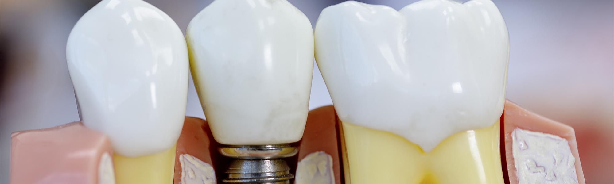 Dental Implants in Whittier CA