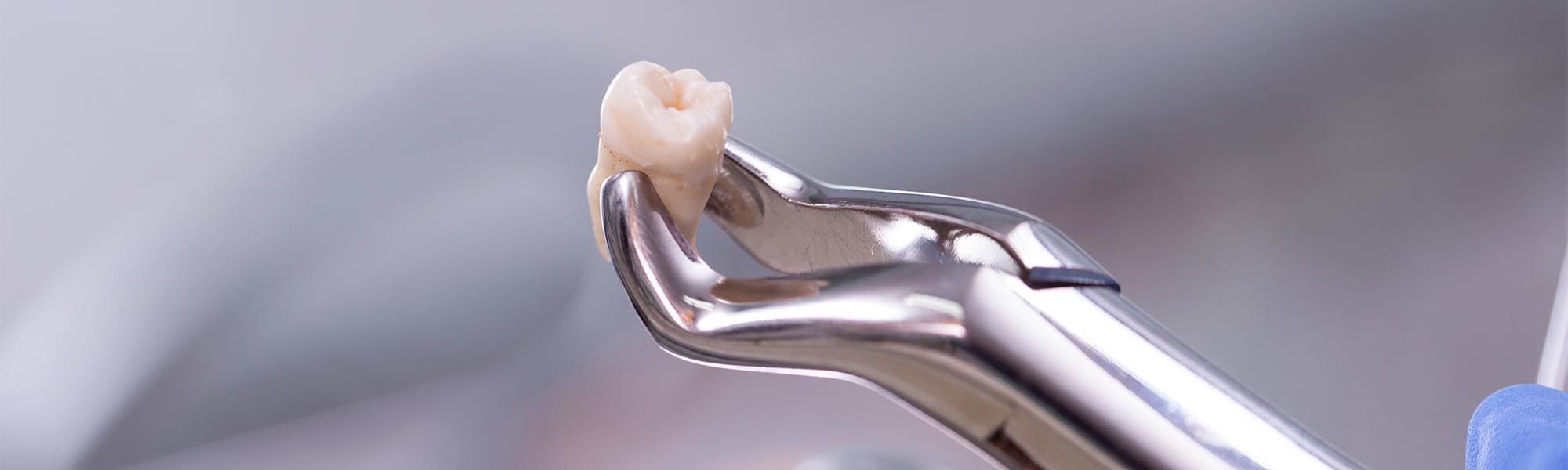 Tooth Extraction in Whittier CA